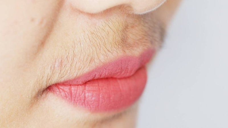 What is hirsutism, this excessive hair growth that affects some women ?