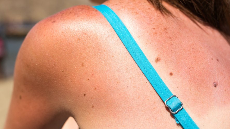 What is anti-sunscreen, this trend supported by influencers and which worries dermatologists ?