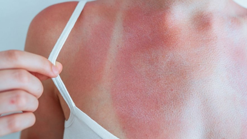 Redness, pain, swelling... sunburn, a summer threat not to be taken lightly