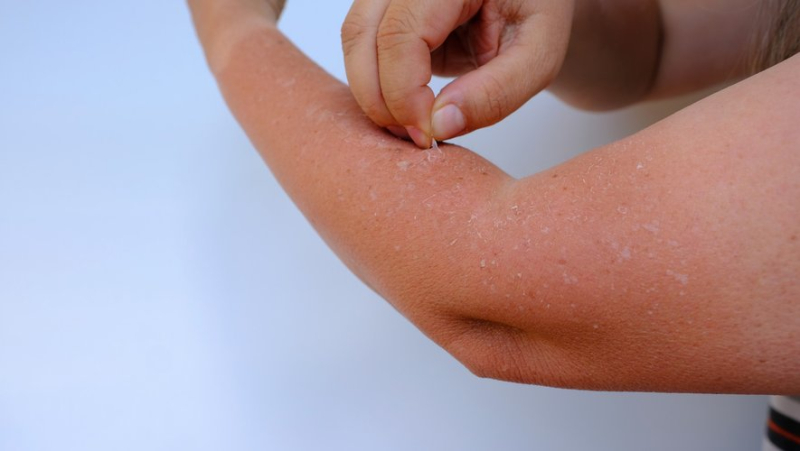 You&#39;ve got sunburn and your skin is "peeling"... find out why and how to treat it