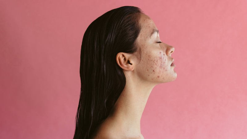 Sunburn To Get Rid Of Acne ? This Crazy Remedie Trending On TikTok Is Not Safe