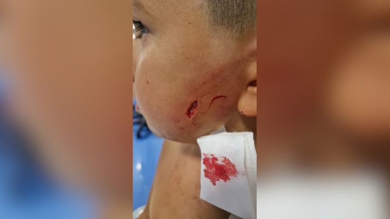 "I thought this dog was going to kill my son, we were really scared": the mother of the child bitten in the face reflects on the attack