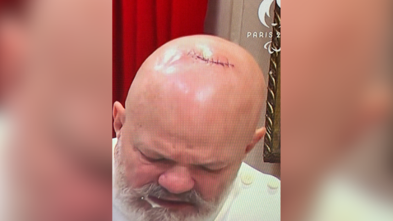 Fort Boyard : pourquoi Philippe Etchebest s’est-il retrouvé avec des points de suture sur le crâne en pleine épreuve de l’émission ?