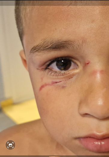 "I thought this dog was going to kill my son, we were really scared": the mother of the child bitten in the face reflects on the attack