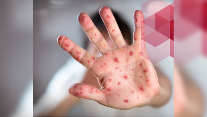 ARS Occitanie warns of 11 cases of measles in Millau "the majority of cases are not vaccinated"